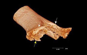 Νέα στοιχεία για τη νεολιθική ιατρική