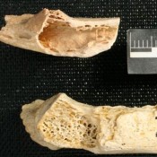 Ανακαλύφθηκε η αρχαιότερη νεοπλασία